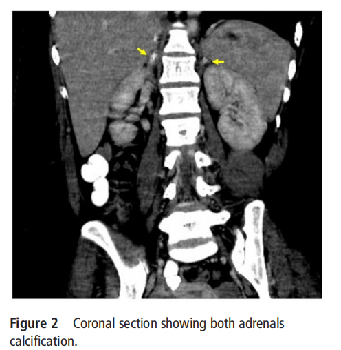 Coronal section showing both adrenals  calcification.